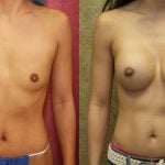 Breast Augmentation Before & After Patient #10432