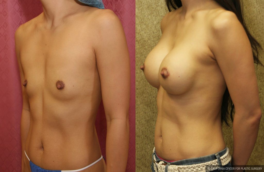 Breast Augmentation Before & After Patient #10432