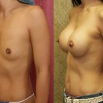 Breast Augmentation Before & After Patient #10432
