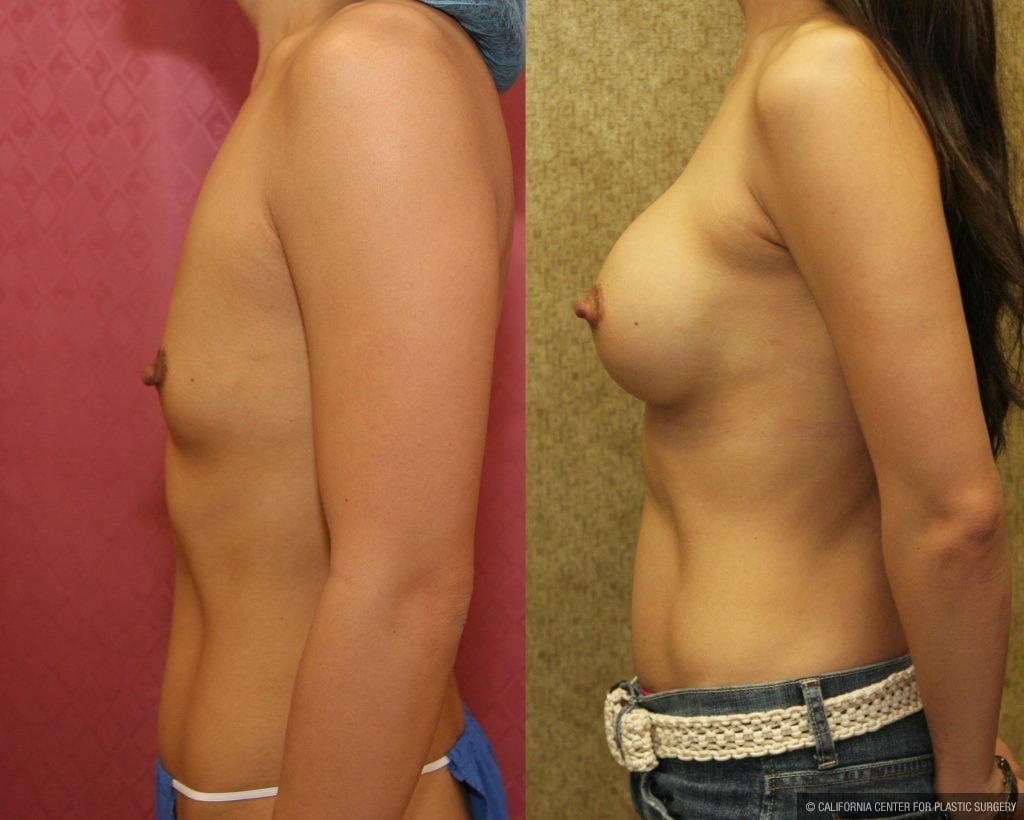 Breast Augmentation Before & After Patient #10432