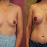 Breast Augmentation Before & After Patient #10436