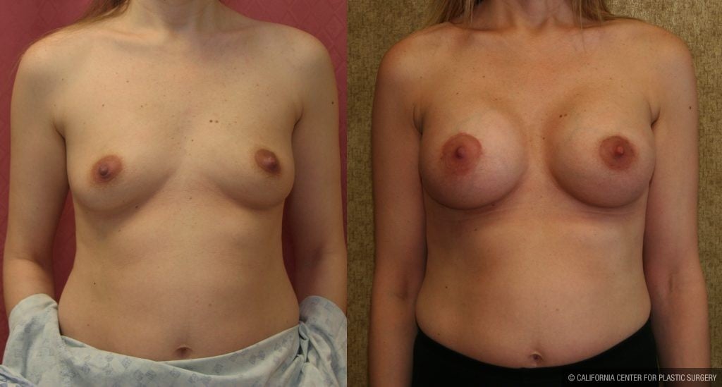 Breast Augmentation Before & After Patient #10275