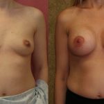 Breast Augmentation Before & After Patient #10275