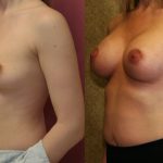 Breast Augmentation Before & After Patient #10275