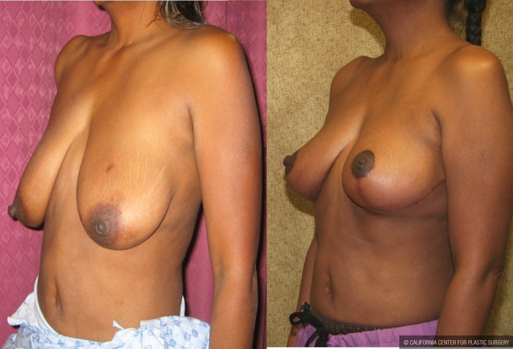 Breast Augmentation Before & After Patient #10440