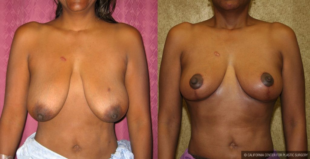 Breast Augmentation Before & After Patient #10440