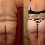 Body Contouring Before & After Patient #10419