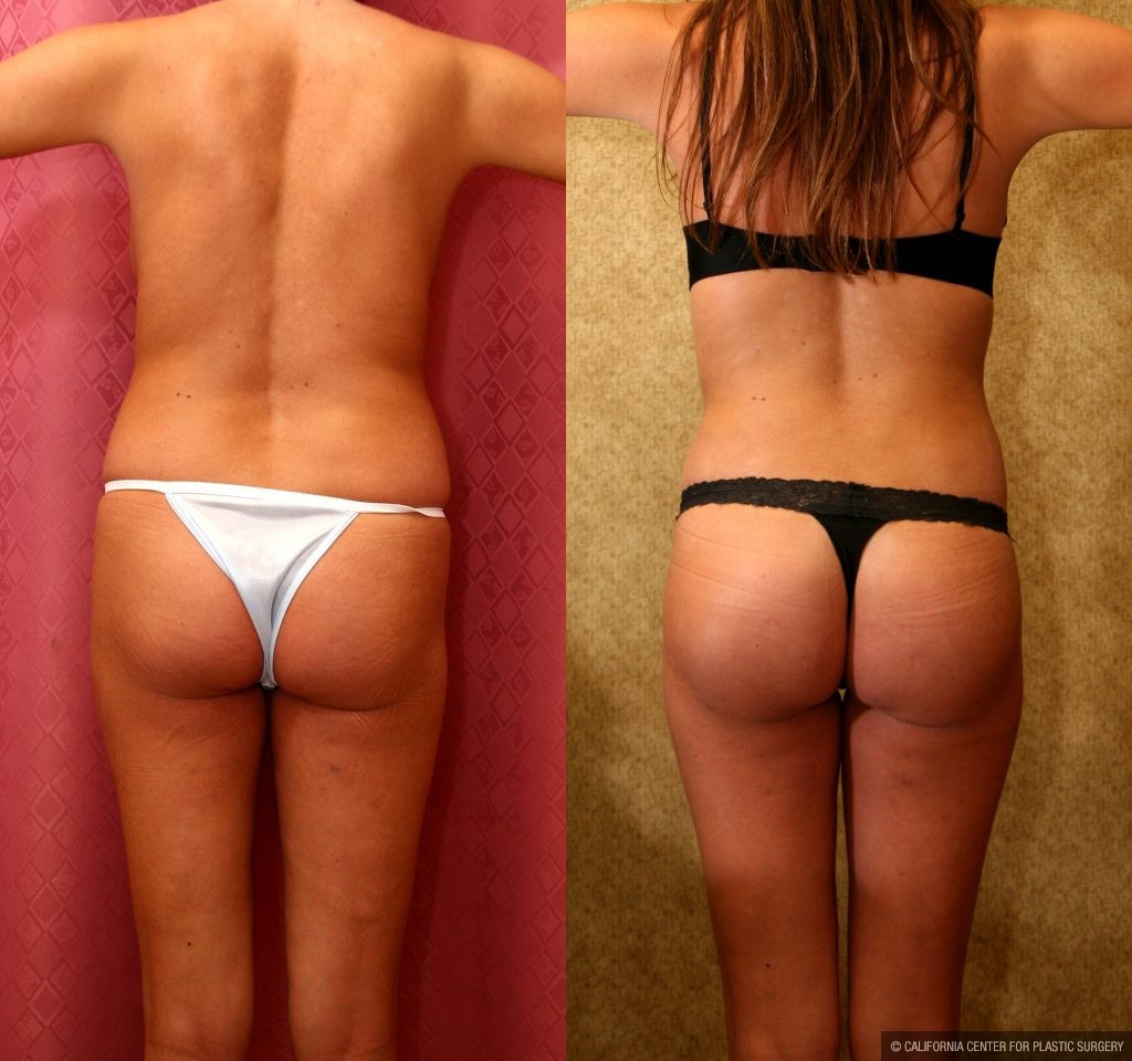Body Contouring Before & After Patient #10407