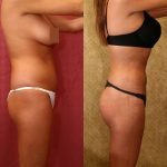 Body Contouring Before & After Patient #10407