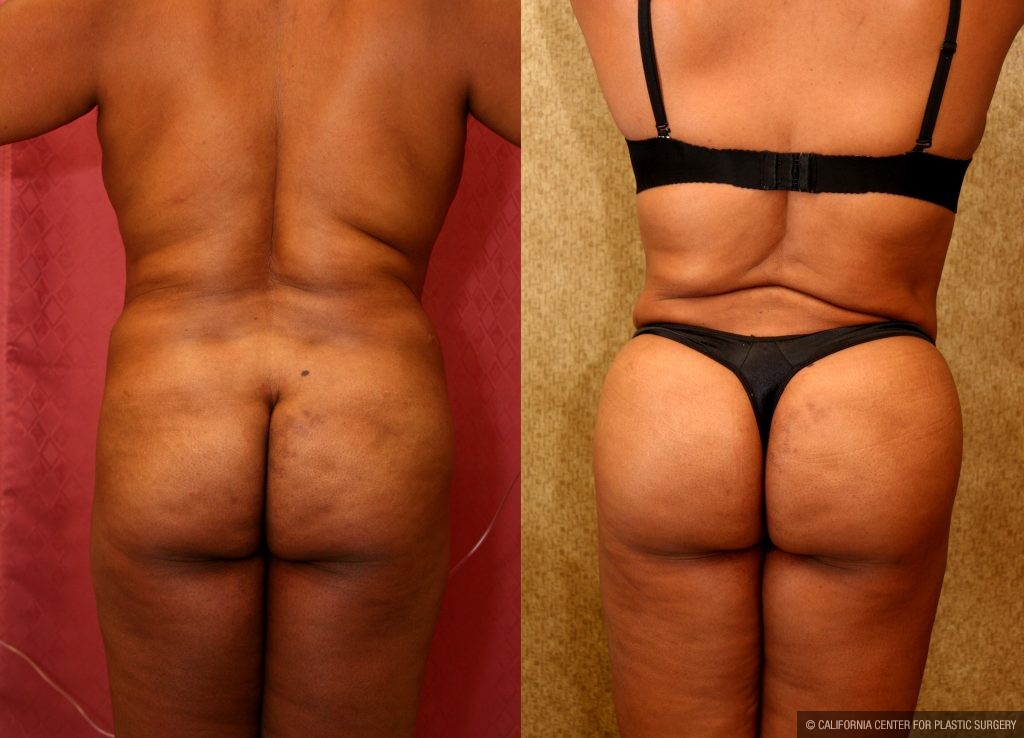 Body Contouring Before & After Patient #10413