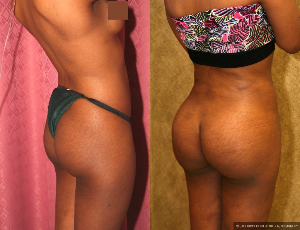 Body Contouring Before & After Patient #10404