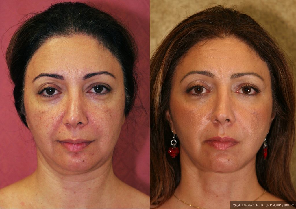 Facial Cosmetic Surgery Before & After Patient #10454