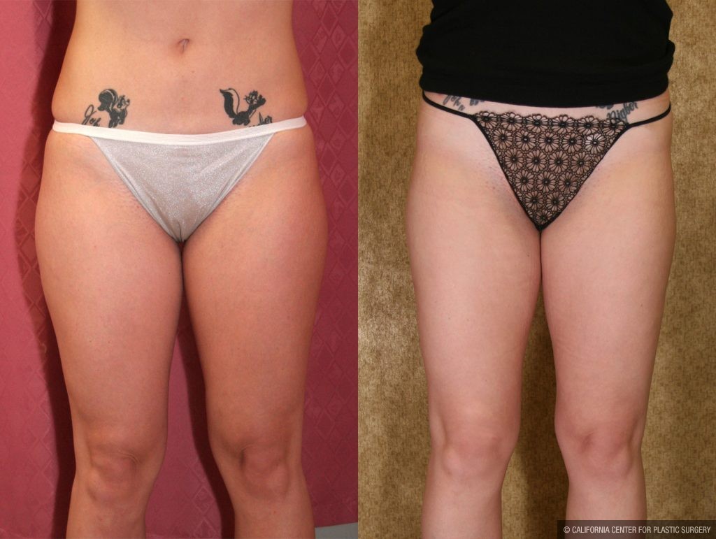 Body Contouring Before & After Patient #10327