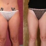 Body Contouring Before & After Patient #10327