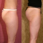 Body Contouring Before & After Patient #10327