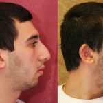 Male Rhinoplasty Before & After Patient #10449