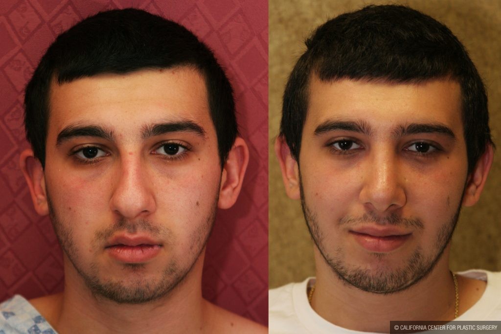 Male Rhinoplasty Before & After Patient #10449