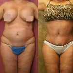 Body Contouring Before & After Patient #10350