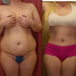 Body Contouring Before & After Patient #10346