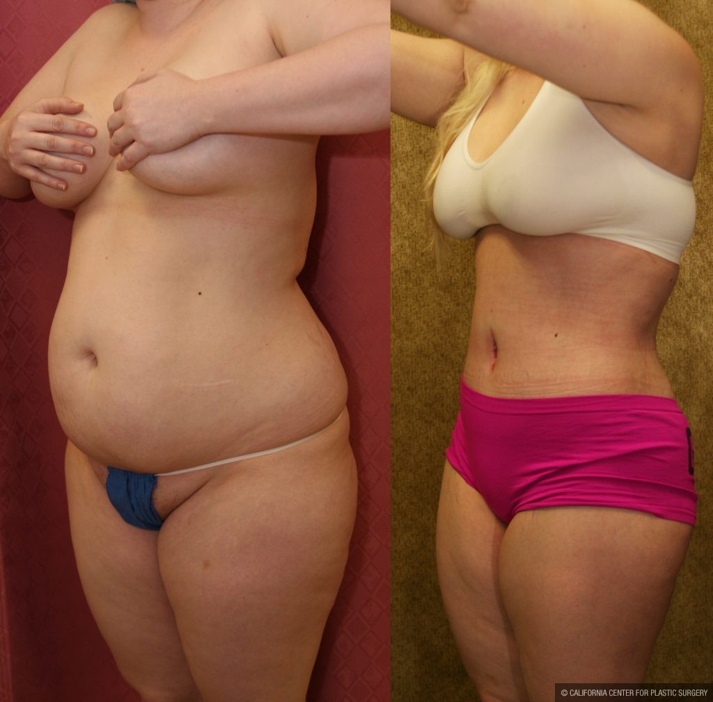 Body Contouring Before & After Patient #10346
