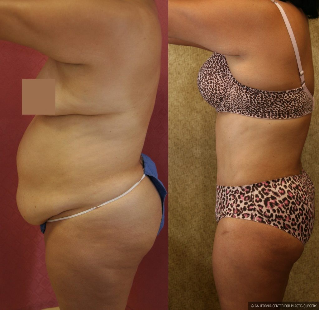 Body Contouring Before & After Patient #10396