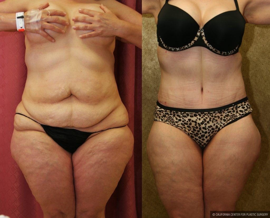 Body Contouring Before & After Patient #10290