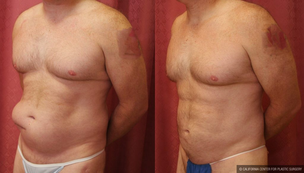 Male Liposuction Abdomen Before & After Patient #10279