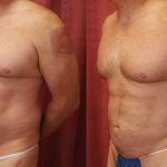 Male Liposuction Abdomen Before & After Patient #10279