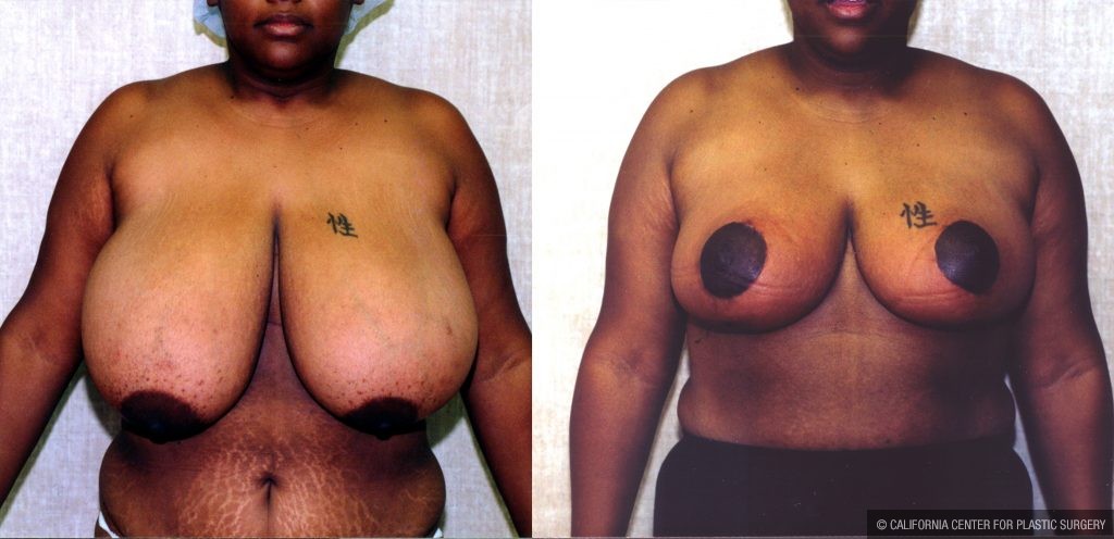Breast Enhancement Before & After Patient #10493