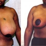 Breast Enhancement Before & After Patient #10493