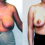 Breast Enhancement Before & After Patient #10489