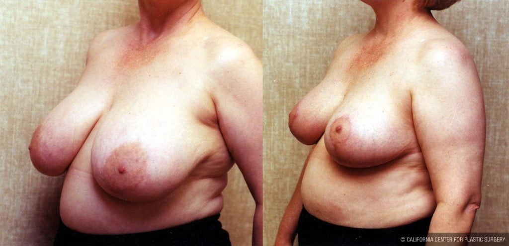 Breast Enhancement Before & After Patient #10496