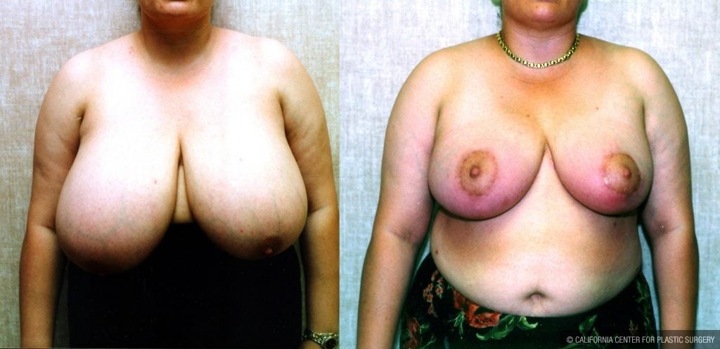 Breast Enhancement Before & After Patient #10499