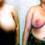 Breast Enhancement Before & After Patient #10499