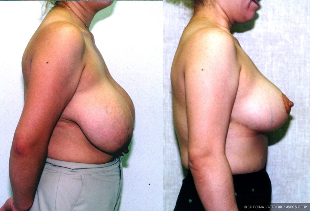 Breast Enhancement Before & After Patient #10489