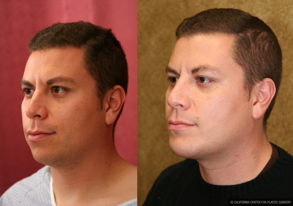 Facial Cosmetic Surgery Before & After Patient #10461