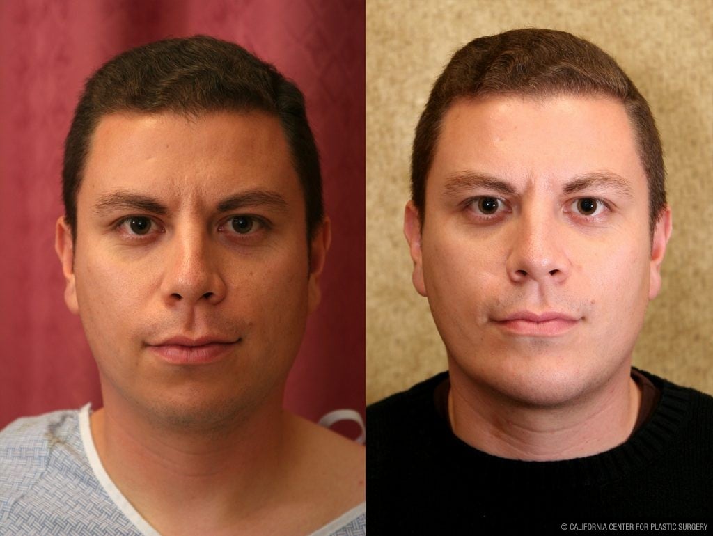 Facial Cosmetic Surgery Before & After Patient #10461