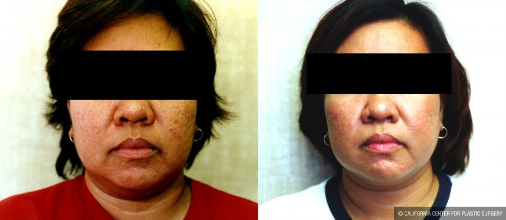 Facial Cosmetic Surgery Before & After Patient #10486