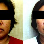 Facial Cosmetic Surgery Before & After Patient #10486