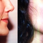 Facial Cosmetic Surgery Before & After Patient #10469