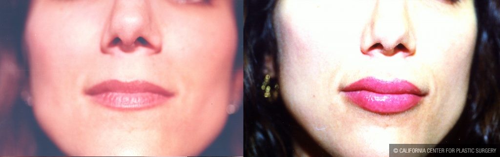 Facial Cosmetic Surgery Before & After Patient #10469