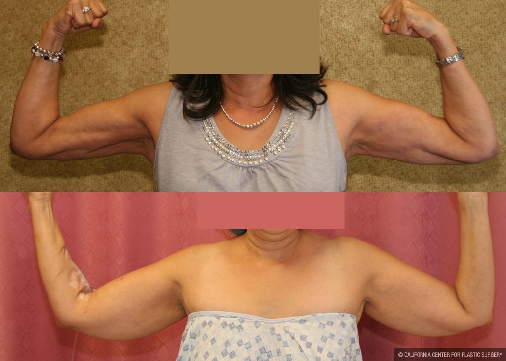 Body Contouring Before & After Patient #10287