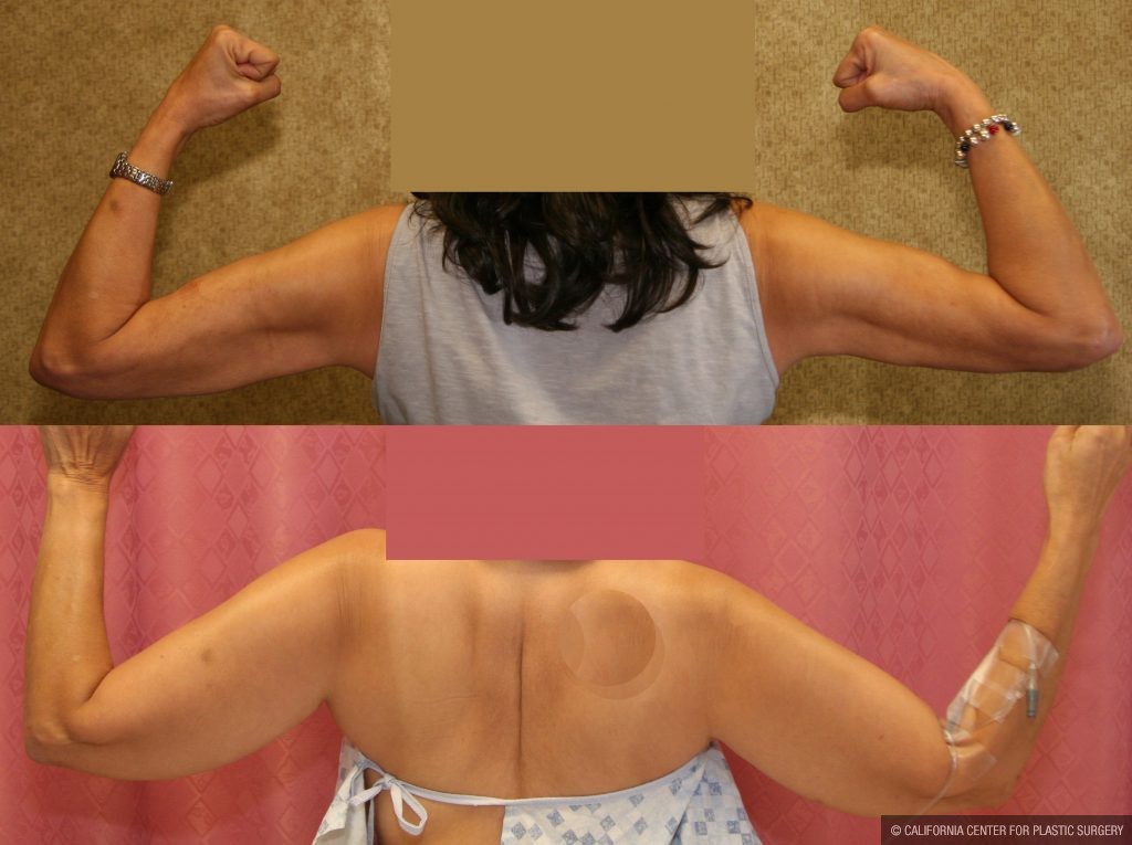 Body Contouring Before & After Patient #10287
