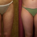 Body Contouring Before & After Patient #10332