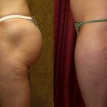 Body Contouring Before & After Patient #10332