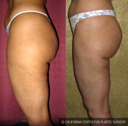 Body Contouring Before & After Patient #10336