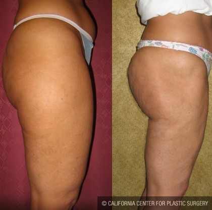 Body Contouring Before & After Patient #10336