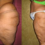 Body Contouring Before & After Patient #10339