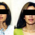 Facial Cosmetic Surgery Before & After Patient #10482