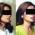 Facial Cosmetic Surgery Before & After Patient #10482